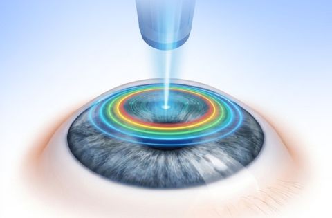 Contoura Vision LASIK treatment